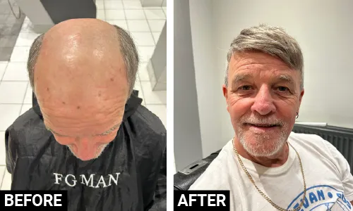 Before and After Hair Replacement System - FG MAN