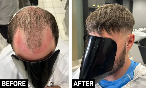 Before and After Hair Replacement System - FG MAN